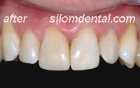 Before dental extreme makeovers, dental filling bangkok clinic