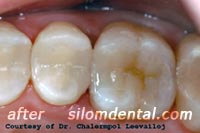 after composite filling bangkok