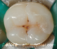 dental caries