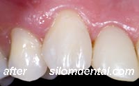 after dental extreme makeovers thailand, dental filling thailand dental clinic