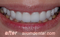 After Dental Extreme Makeovers thailand, porcelain veneer bangkok