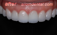 After Dental Makeovers clinic thailand, dental veneer clinic bangkok