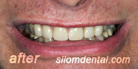 After Dental Makeovers, porcelain veneers