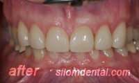 After Dental Extreme Makeover, dental veneers