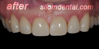 After Dental Extreme Makeover, dental veneers