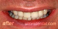 After Dental veneers bangkok thailand