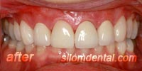 After Porcelain veneers Bangkok Thailand