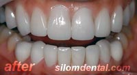 After Dental Extreme Makeovers thailand, porcelain veneer bangkok