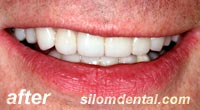 After Dental Extreme Makeovers, dental veneers