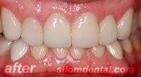 After Dental Makeovers, porcelain veneers