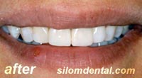 After Dental Makeovers, porcelain veneers