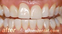 After Dental Extreme Makeover, dental veneers