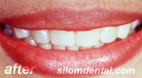 After smile makeover thailand, porcelain veneers thailand