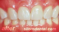 After smile makeover bangkok dental clinic, porcelain veneer bangkok dental clinic