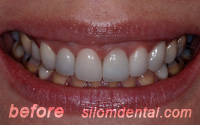 Before Dental Extreme Makeovers bangkok, porcelain veneers thailand