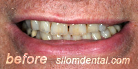 Before Dental Makeovers, porcelain veneers