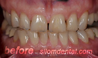 Before Dental Extreme Makeover, porcelain veneers