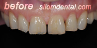 Before Dental Extreme Makeover, porcelain veneers