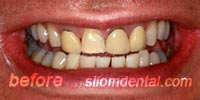 Before Dental veneers bangkok thailand