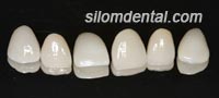 crowns and veneer