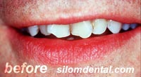 Before Dental Extreme Makeovers, dental veneers