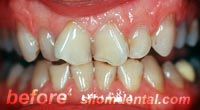 Before Dental Makeovers, porcelain veneers