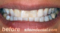 Before Dental Makeovers, porcelain veneers