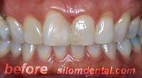 Before Dental Extreme Makeover, porcelain veneers