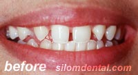 Before smile makeover bangkok, porcelain veneers bangkok