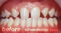 Before smile makeover dental clinic, porcelain veneer dental clinic