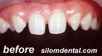 Before smile makeovers thailand dental clinic, porcelain veneers thailand dental clinic