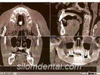 ILUMA CT scan for MPR and Oblique images