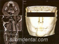 ILUMA CT scan for surface renering