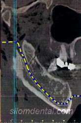 ILUMA CT scanner for Orthodontic and Implants Applications in Dental Clinic Bangkok