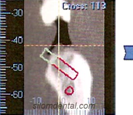 ILUMA CT scanner for Orthodontic and Implants Applications in Bangkok Dental Clinic Thailand