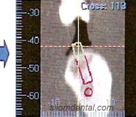 ILUMA CT scanner for Orthodontic and Implants Applications in Bangkok Dental Clinic Thailand