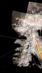 ILUMA CT scanner for Orthodontic and Implants Applications in Dental Clinic Thailand