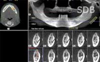 i-CAT Cone Beam 3-D image