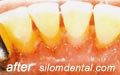 Dental scaling