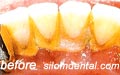 Dental scaling