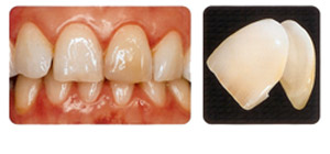 IPS Empress Veneer