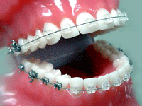 การจัดฟันด้านนอกแบบเซรามิค