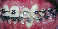 การจัดฟันแบบ Damon system