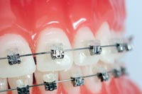 การจัดฟันแบบ Damon System