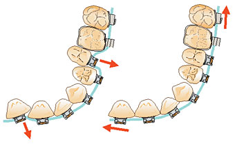 Damon efficient tooth movement