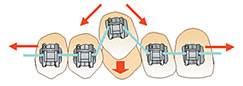 Damon efficient tooth movement