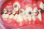 Damon efficient tooth movement