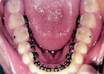 ภาพการจัดฟันด้านในด้านล่าง