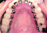 ภาพการจัดฟันด้านในด้านบน