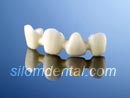 Procera Alumina Bridge